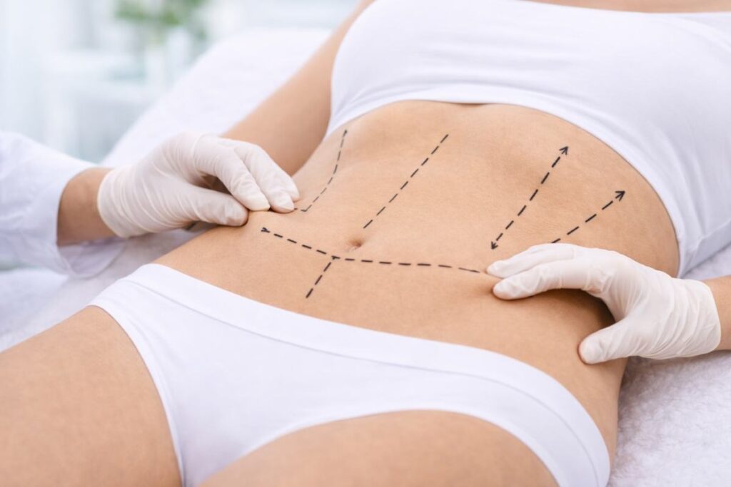abdominoplastia cirugia estetica abdomen clinicare