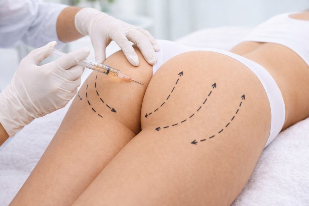 cirugia bbl levantamiento gluteos clinicare