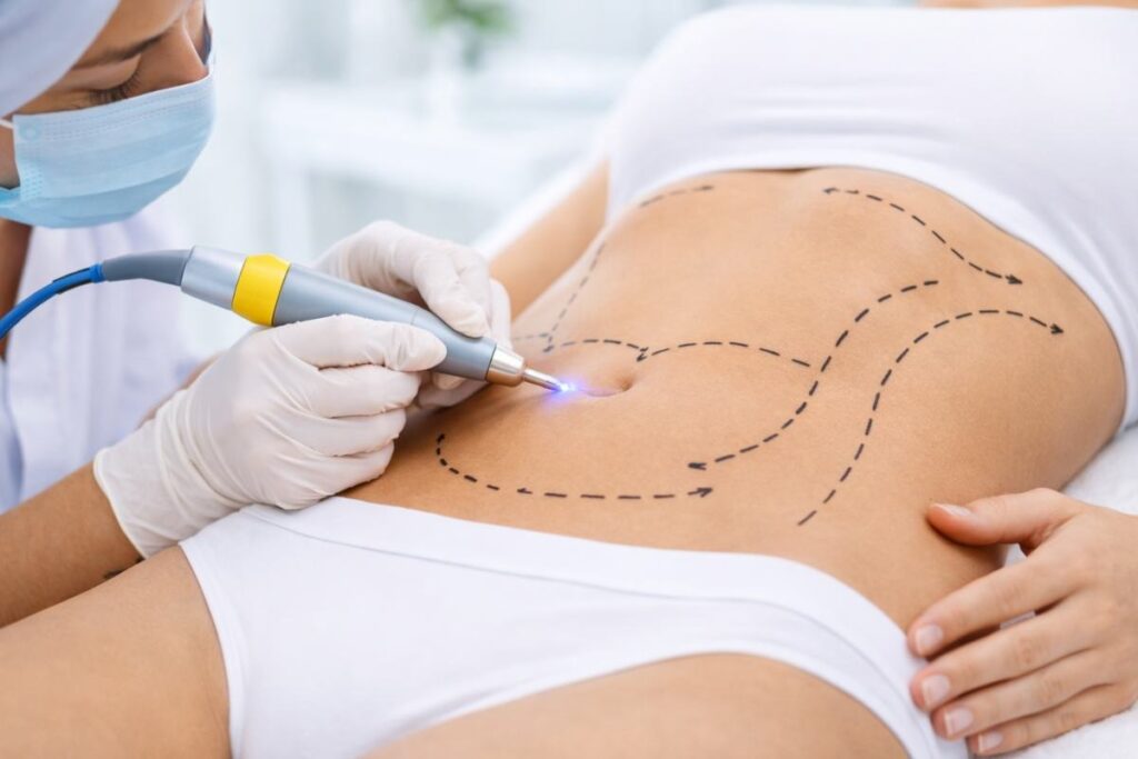 liposuccion lipovaser clinicare